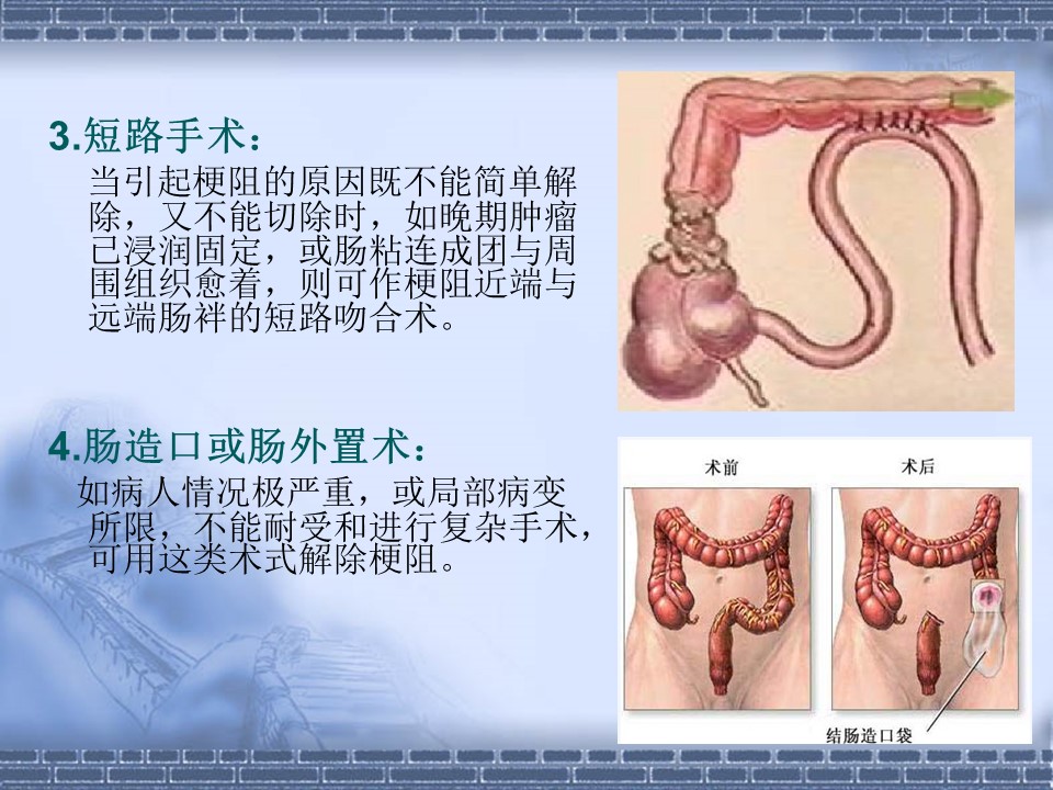 肠梗阻
