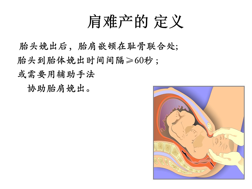肩难产口诀PPT