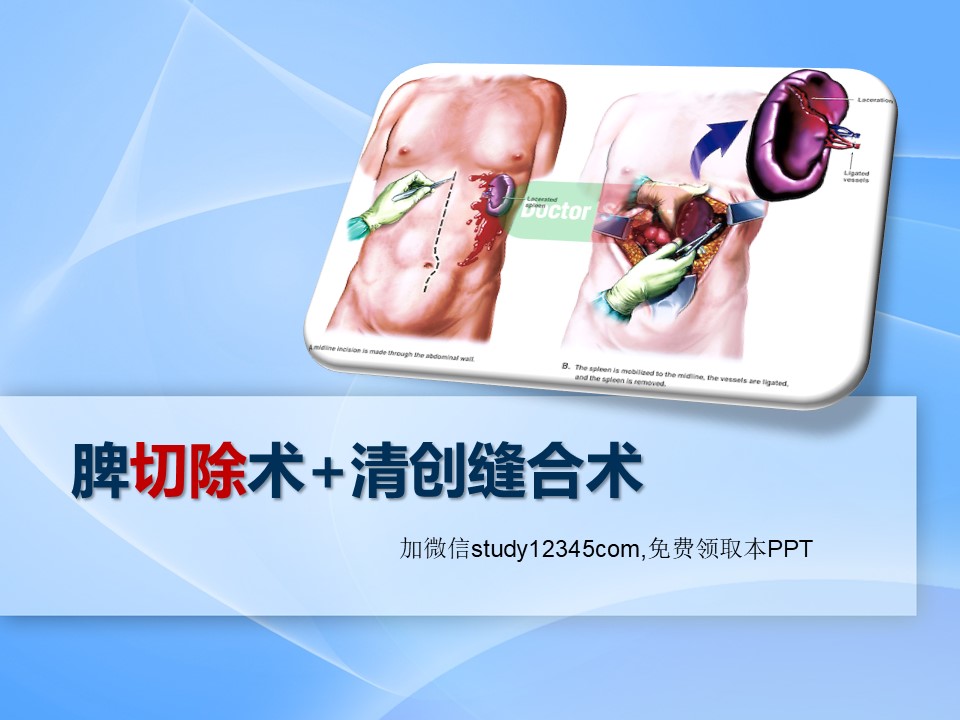 脾切除术+清创缝合术