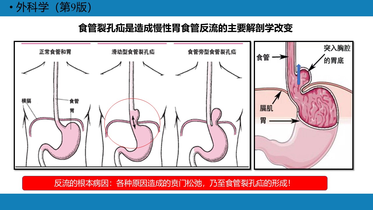 胃食管反流病3